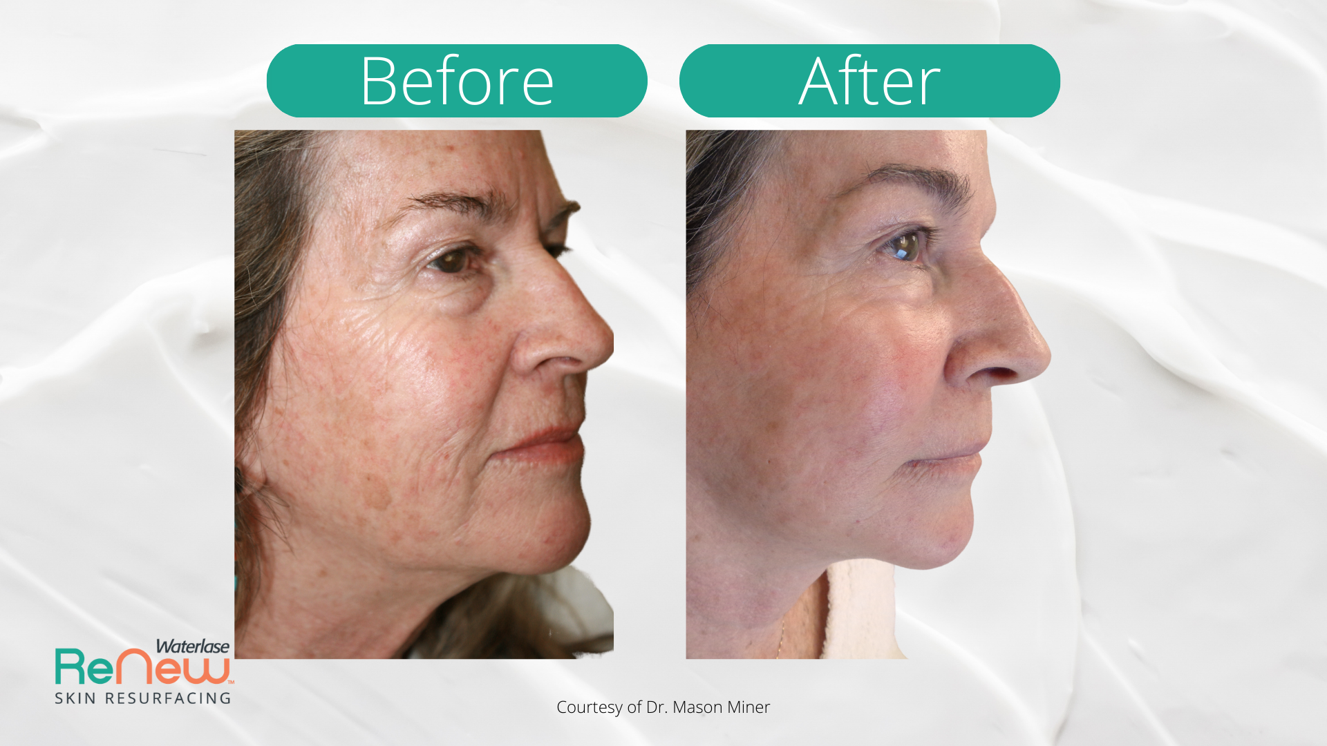 The image shows a before-and-after comparison of a person s skin, highlighting the results of a cosmetic treatment with text indicating before and after.