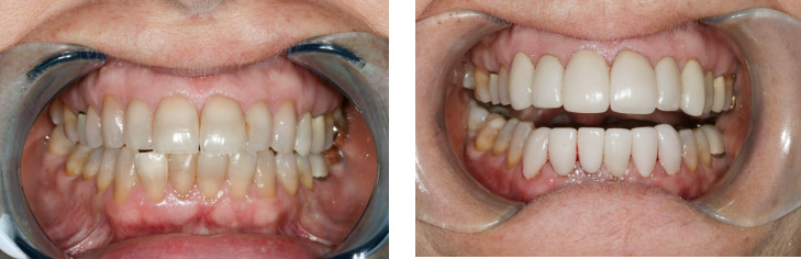 This is a split-screen photograph showing two different stages of teeth whitening treatment before and after.