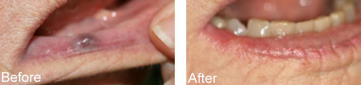 The image shows a person s mouth with teeth removed, and there is text indicating an after view of dental work.
