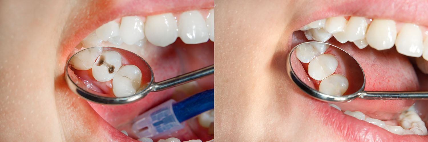 The image shows a person with an open mouth wearing dental braces, holding a magnifying glass, and displaying their teeth.