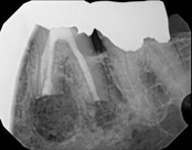 3-month follow-up after Apicoectomy