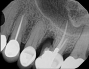 After root amputation