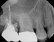 Root canal treatment